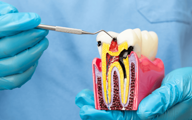 root canal dubai