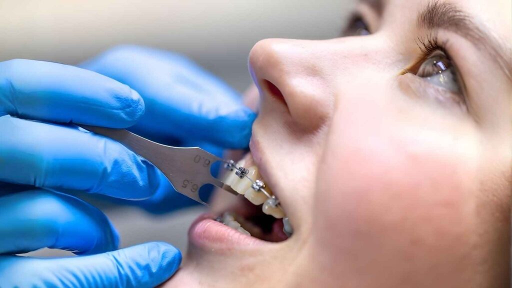 Braces Procedure Steps