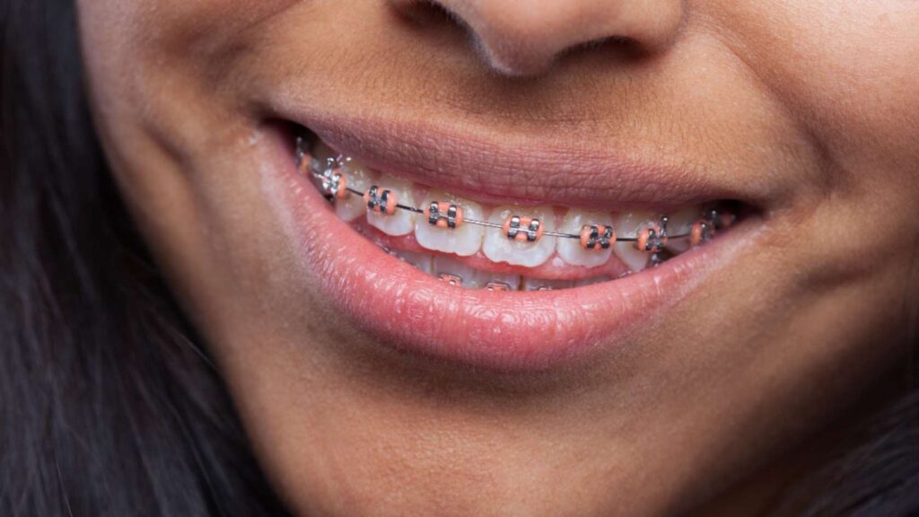types of dental braces