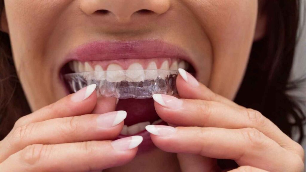 types of dental braces