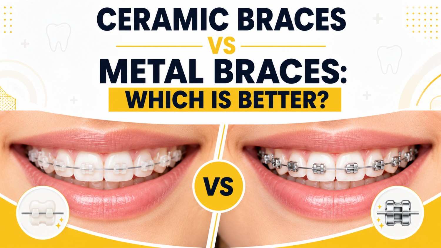 Ceramic Braces vs Metal Braces: Which Is Better comparison showing ceramic and metal orthodontic brackets.